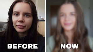 I hated My Piggy Nose Job. (Spoiler: It Gets Better!) I hated My Piggy Nose Job. (Spoiler: It Gets Better!)