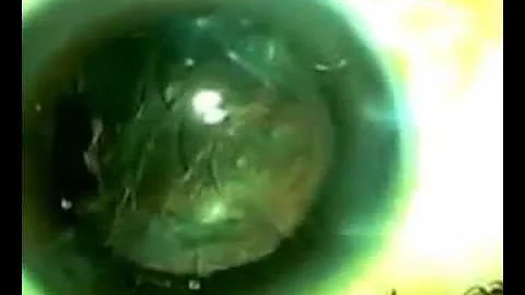 Pop and Chop  - Phaco Technique Fredric Gross MD