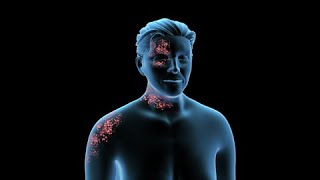 ¿Cómo se detecta la culebrilla?