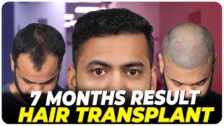 Hair Transplant in Kerala | Best Results & Cost of Hair Transplant in Kerala