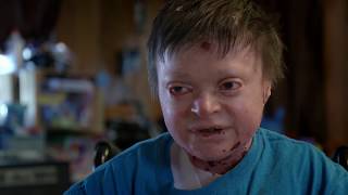 Download Epidermolysis Bullosa (EB) sufferer Jonathan Gionfriddo | The Boys With No Skin | Channel 5 Epidermolysis Bullosa (EB) sufferer Jonathan Gionfriddo | The Boys With No Skin | Channel 5