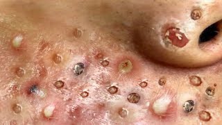 Loan Nguyen Acne Treatment 1553h
