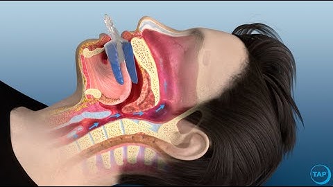 flexTAP Oral Appliance for Sleep Apnea: How Does It Work?