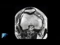 PLC Injury Knee MRI | Posterolateral Corner Knee Injury | Knee Pain Symptoms | Minneapolis, MN
