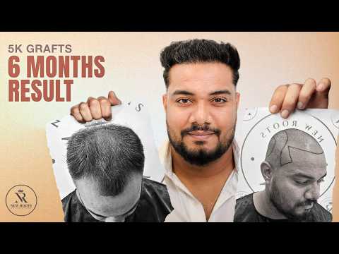 The Before vs After Will Shock You 😳 | Best Hair Transplant Results in Nagpur | New Roots