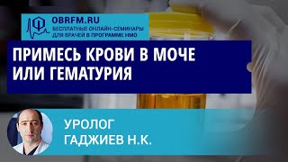Уролог Гаджиев Н.К.: Примесь крови в моче или гематурия