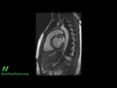 Video: Břišní Aorta - Větve, Ateroskleróza, Ruptura