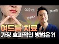 여드름 약이 부작용을 일으킨다?! 여드름 치료 전 꼭 알아야 할 것들!