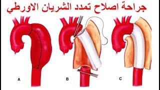 جراحة اصلاح تمدد الشريان الاورطي في الصدر