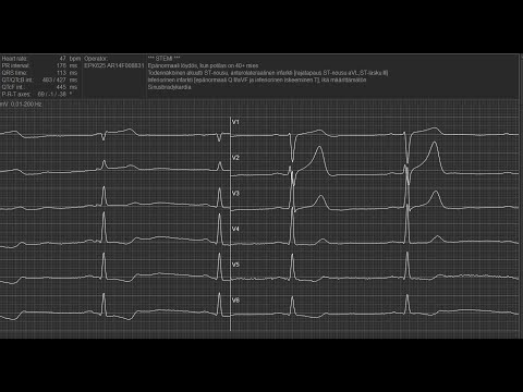 Video: Näkyvätkö sydänkohtaukset EKG:ssä?