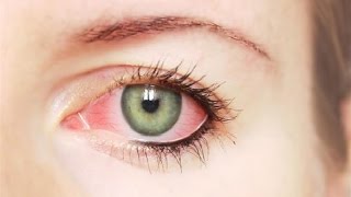 هل احمرار العين حساسية أم عدوى ؟