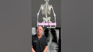 Here’s When Your Scoliosis Gets Worse ↩️↪️ #shorts