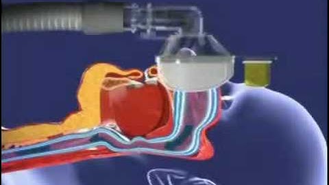 Introduction To Respironics CPAP C-Flex Part 2