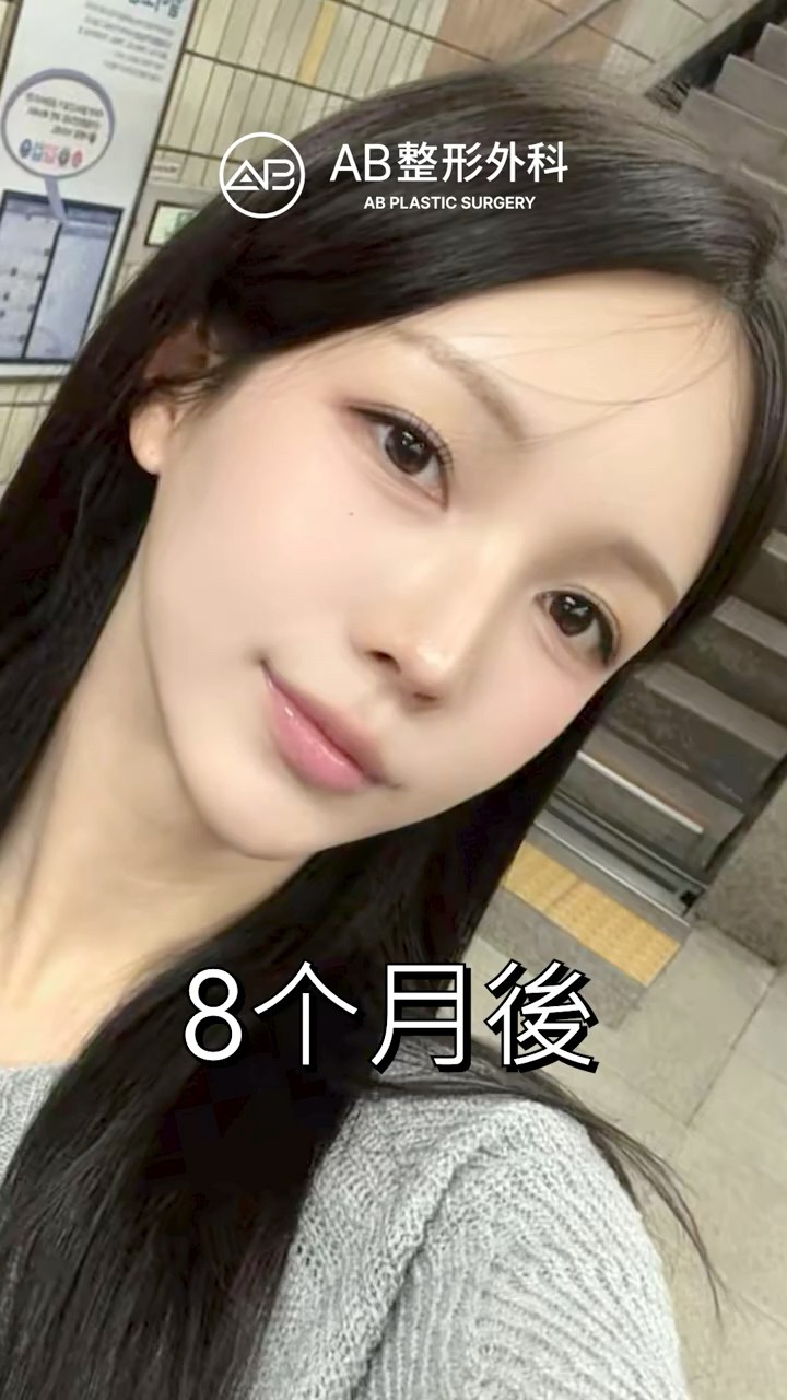 下顎角＋下巴手術前後公開｜臉型差別太明顯 #shorts