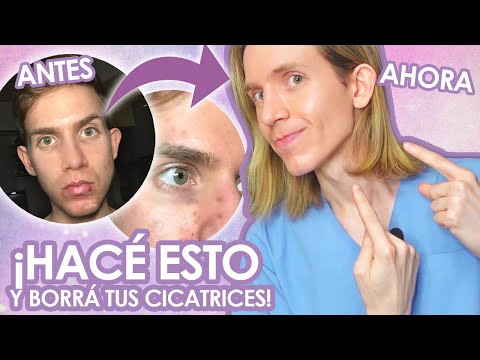 Video: ¿El ácido salicílico elimina las manchas oscuras?