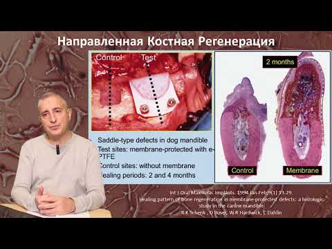 Направленная Костная Регенерация (НКР) Часть 1. Мембраны