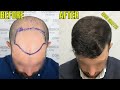 AMAZING HAIR TRANSPLANT TRANSFORMATIONS FOR NORWOOD 5+ HAIR LOSS!