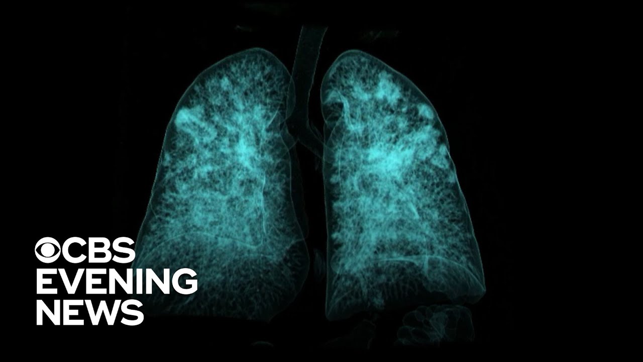How lung scans can play an important role in detecting coronavirus How lung scans can play an important role in detecting coronavirus