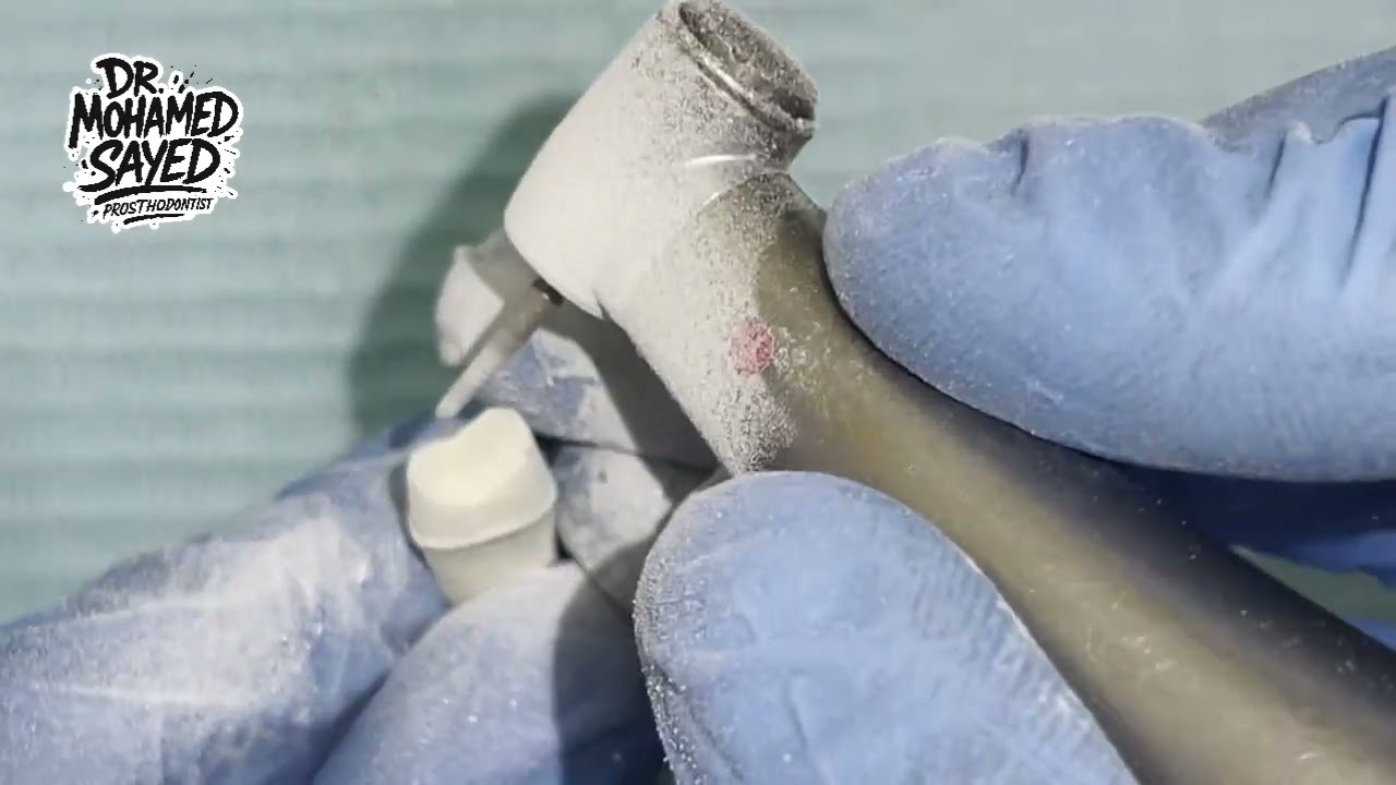 Wingless Preparation for Porcelain-Fused-to-Metal (PFM) Crowns on Upper Premolar #25 #15