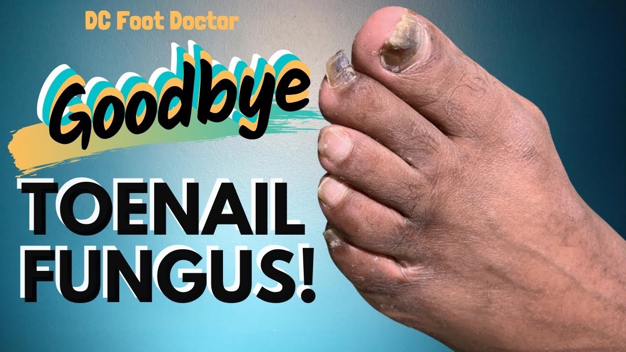 Goodbye Toenail Fungus: Achieving A Successful Outcome - YouTube