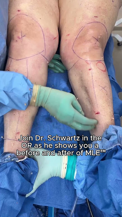 A Closer Look at Manual Lipedema Extraction™