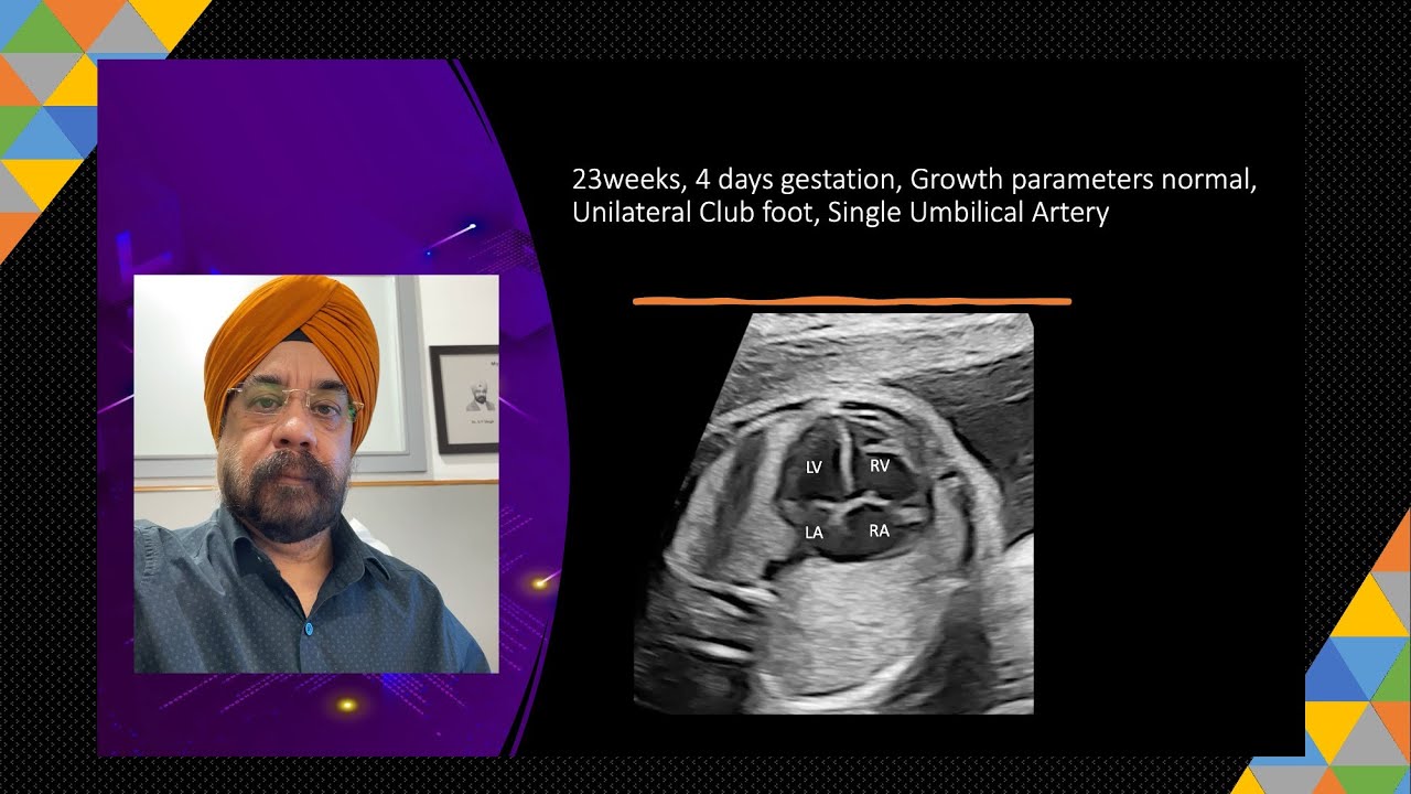 Four Chamber View is Not Normal