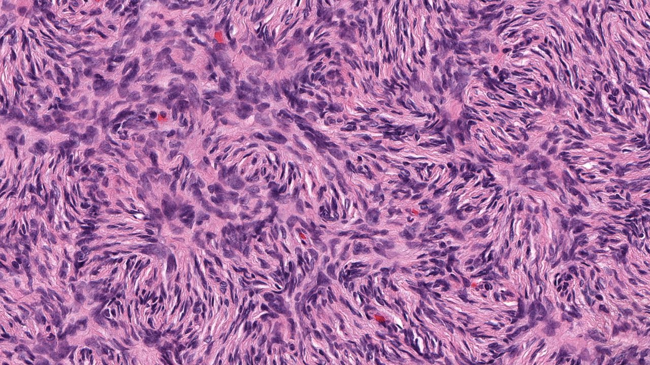 Dfsp Dermatofibrosarcoma With Perfect Storiform Pattern Pathology