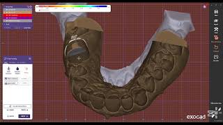 #exocad 1 anatomic crown