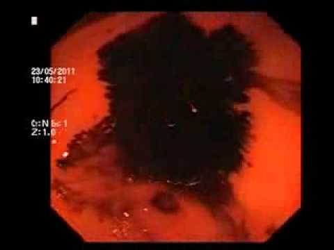 Гастроскопия ДИАНТЕК: тест на кислотность и HP.