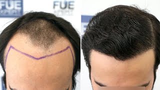 Injerto Capilar FUE (3000 Injertos NW IV-V A) Dr. Juan Couto - FUEXPERT CLINIC - Madrid, España