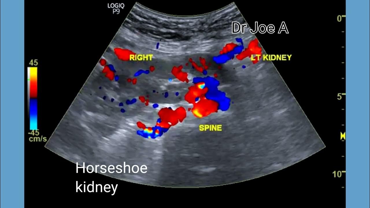 Horseshoe kidney or partial fusion of kidneys ultrasound and color Doppler video YouTube