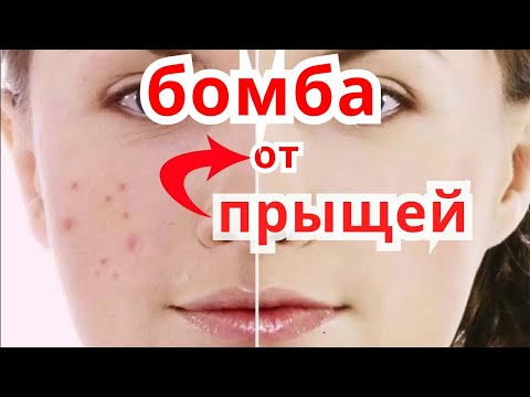 Маски для лица от прыщей и от черных точек в домашних условиях с