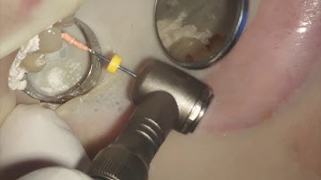 #5 MicroEndo - MicroFlow Obturation