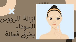 طرق سهلة لازالة الرؤوس السوداء في المنزل