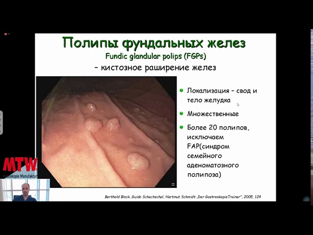 Доброкачественные новообразования желудка. Эндоскопическая диагностика.
