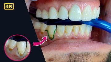 Class 5 Restoration - Gum Line Cavity Restoration