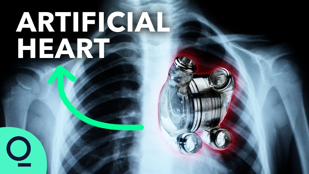 Konstgjorda Hjärtan Kanske Närmare än Man Tror Ska Transplanteras I