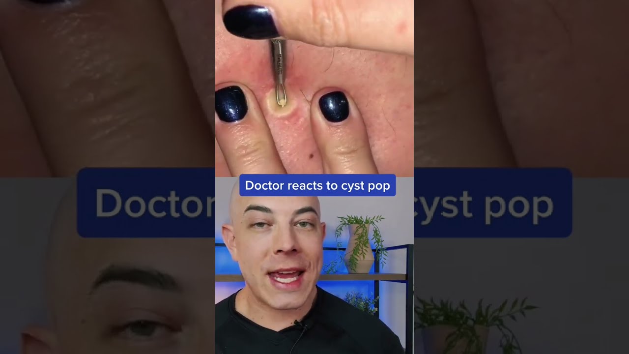 Doctor Reacts To Big Cyst Pop Pimplepop Cystpop Dermreacts