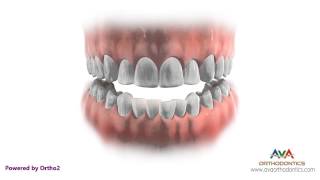 Orthodontics Treatment with Extraction - Removing Different Teeth