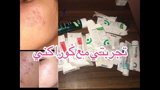 كيفاش تخلصت من حب الشباب ، تجربتي مع كوراكني ?,نصائح ليكم من تجربتي ❤️