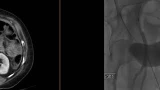 Pseudoaneurysm