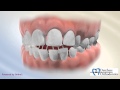 Lingual Holding Arch