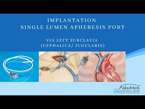 PakuMed Apherese Port Implantation (Demo Film) (deutsch)