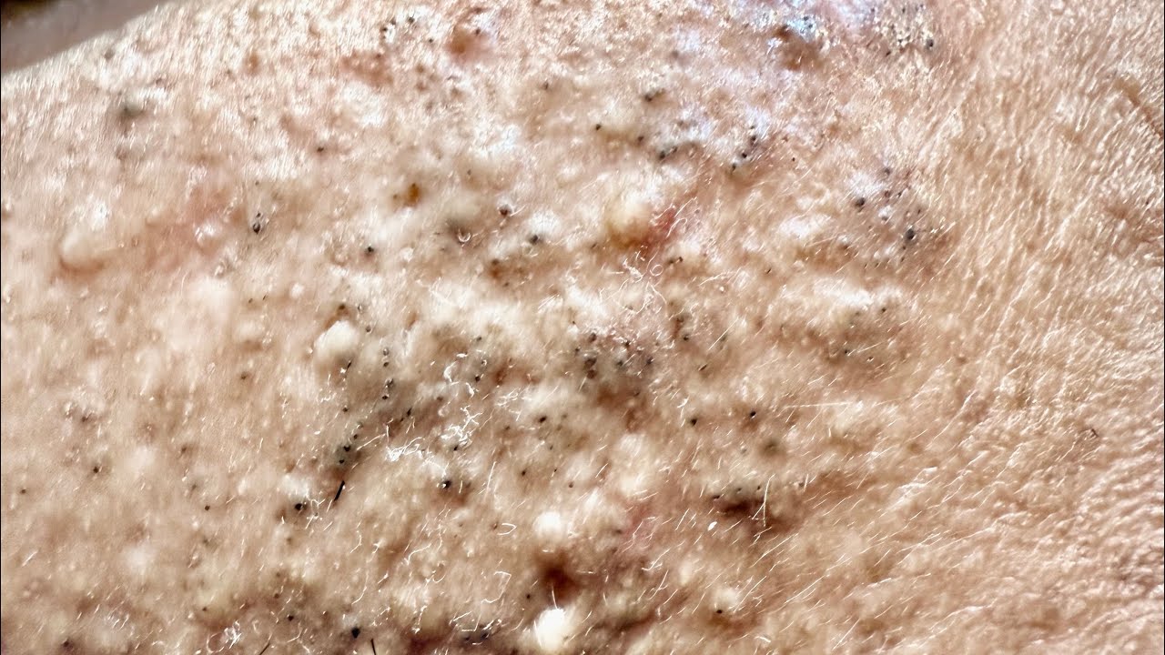 Dirty blackheads and cleaning them