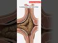 Illustration of constipation and side view | Gut Health | Body Arts Anatomy 3D
