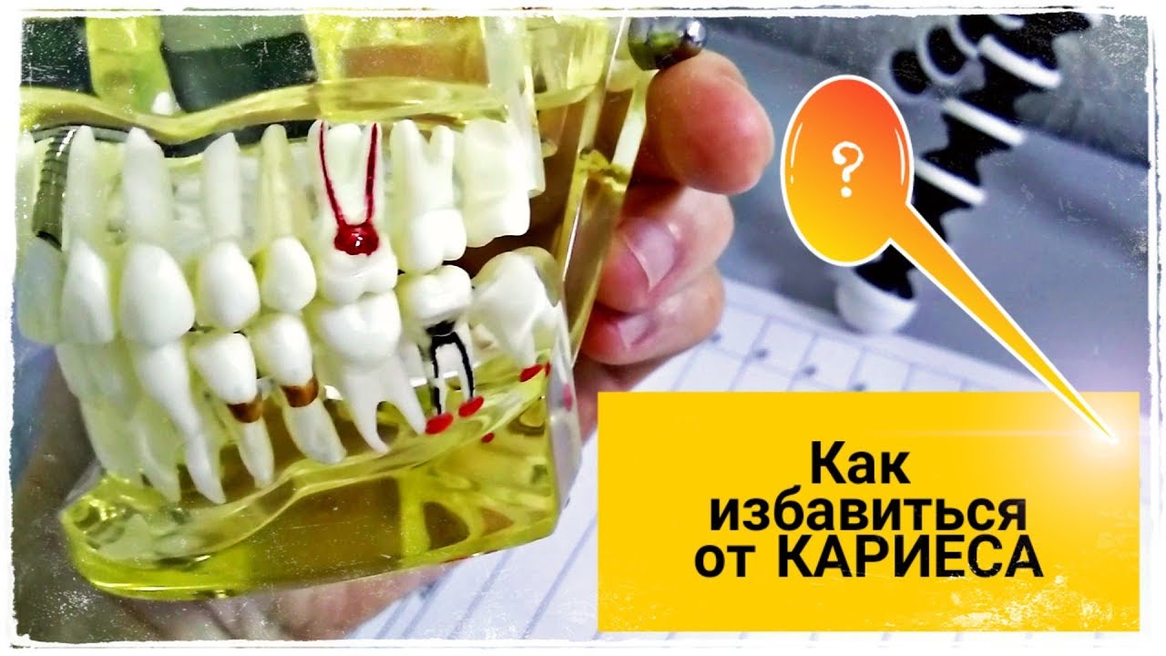 Как Избавиться от Кариеса? - YouTube