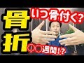 【骨折が治るまで！】骨が付くまでの期間を解説！骨折したの箇所で違う！早い治し方を知っていただきたい！！