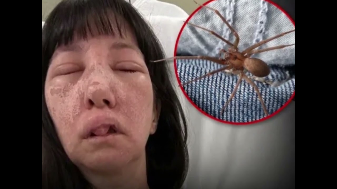 GEORGIA WOMANSPIDER ATTACK LANDS HER IN HOSPITAL ...Painful Rash, Eye Damage