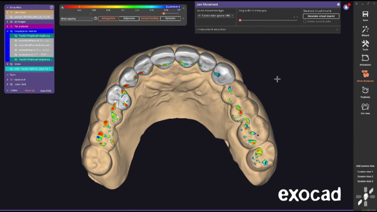 Modjaw™ - Static occlusion is not enough