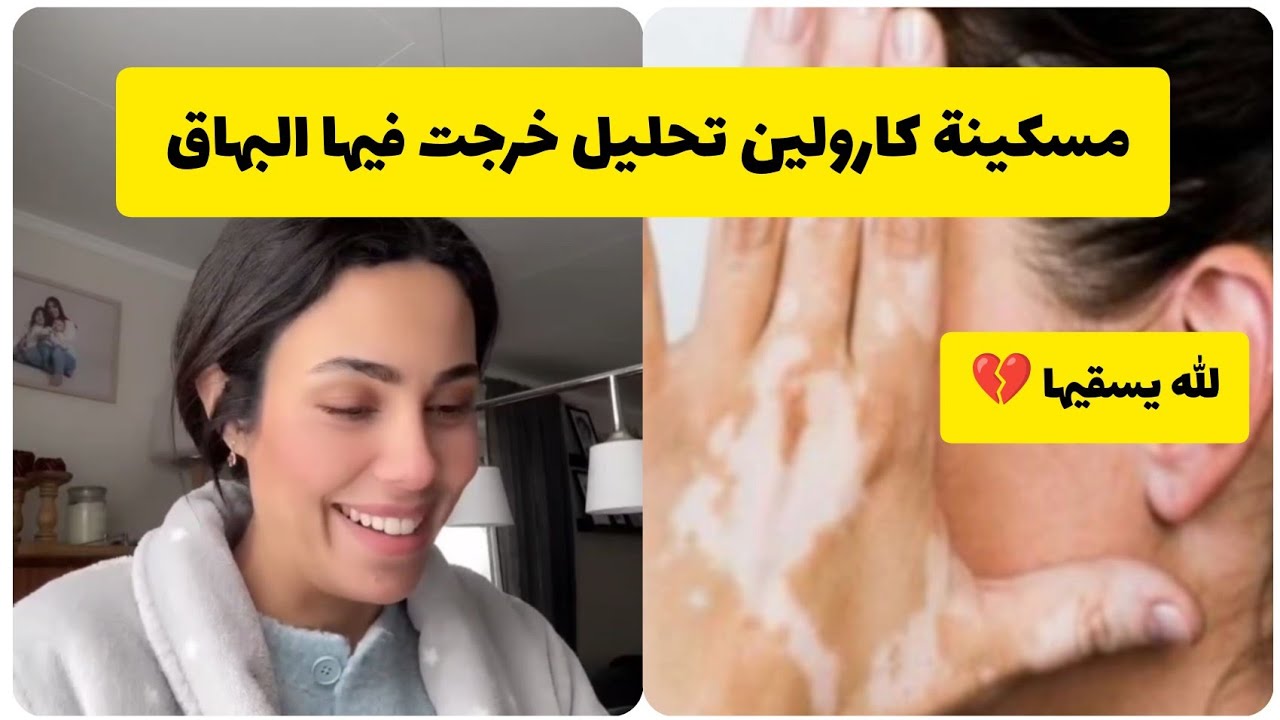 #كارولين مسكينة مريضة بمرض البهاق الله يشفيها لبنات تحليلي خرجت فيهم البهاق واحد يتمسخر بيا في اميل 